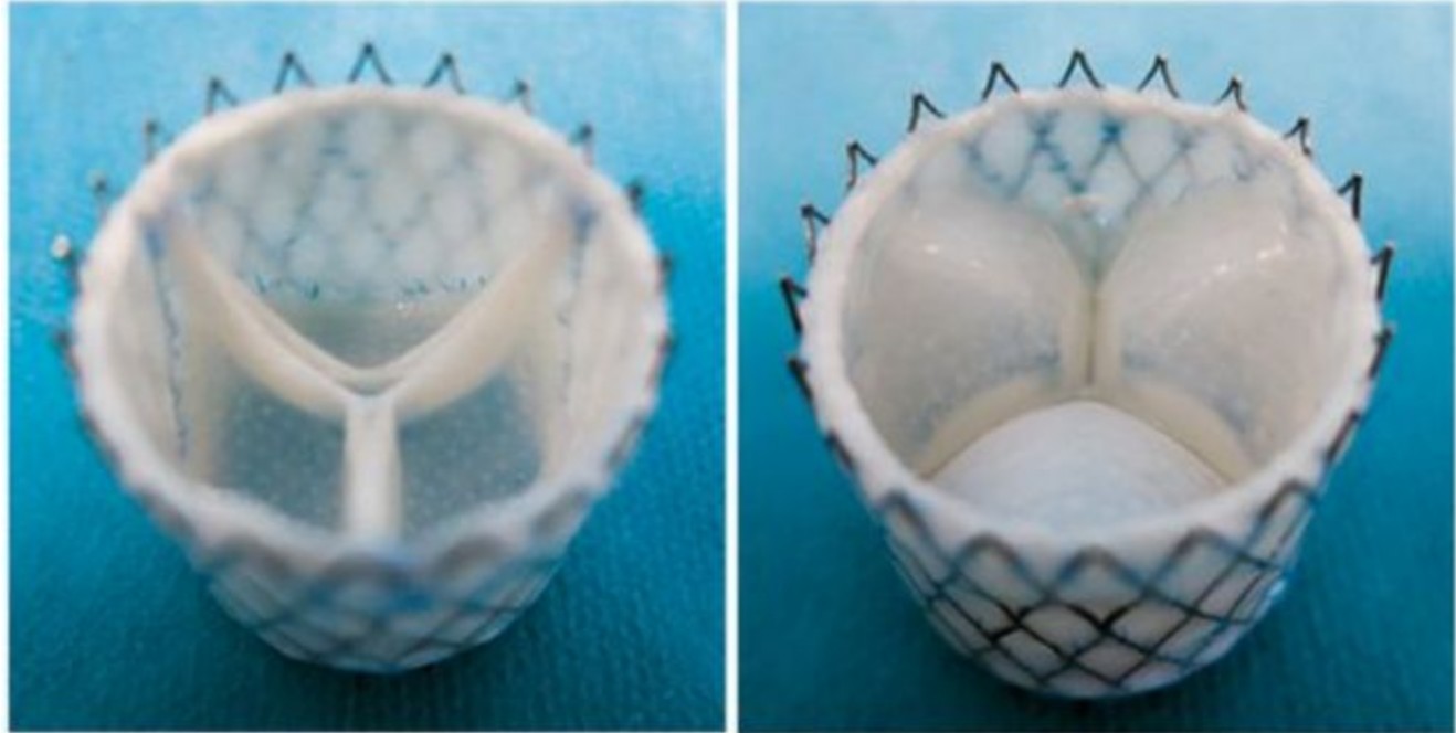 全球首植！自体组织工程瓣膜破局